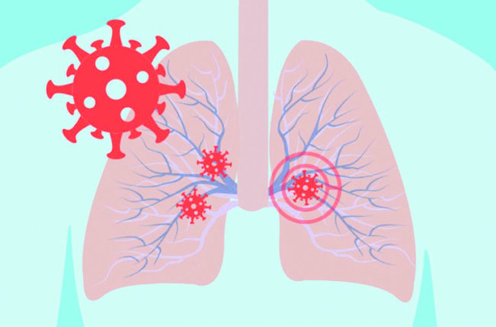 Bệnh viêm phế quản phổi ở trẻ em: Những dấu hiệu cảnh báo trẻ đã mắc bệnh - Ảnh 3